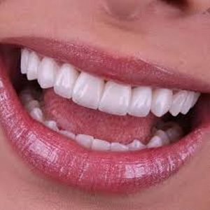 Lentes de contato dental