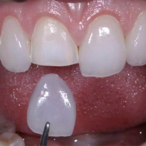 Facetas dentárias